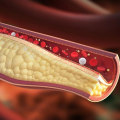 Ipertensione e livelli di colesterolo: cosa devi sapere