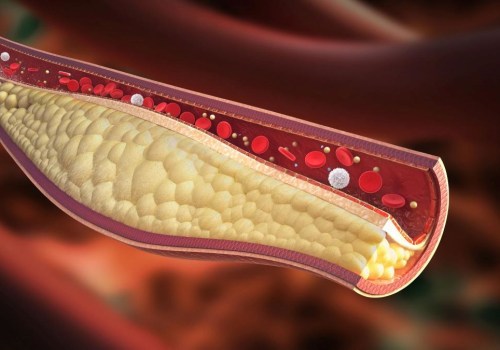 Ipertensione e livelli di colesterolo: cosa devi sapere